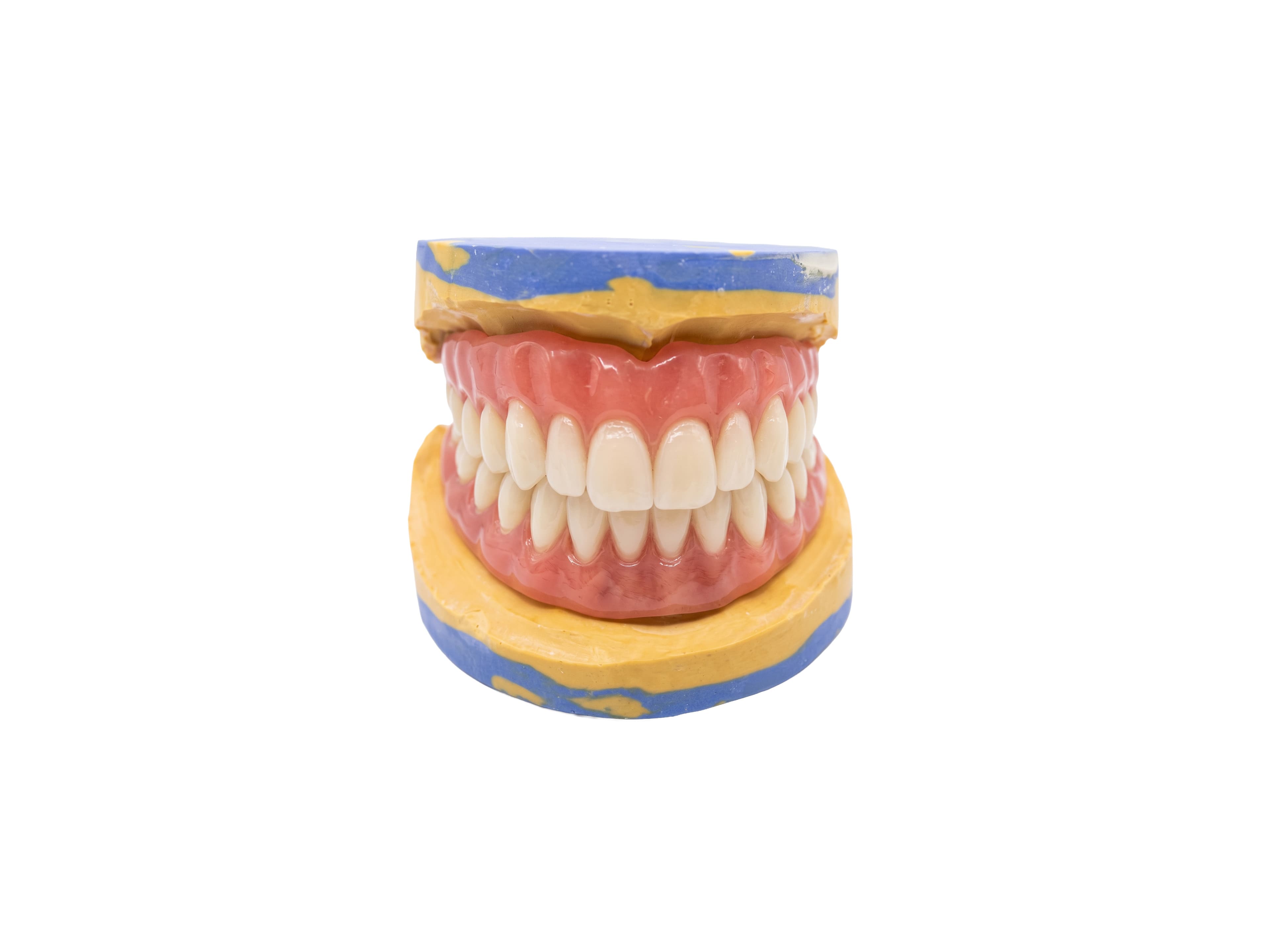 Full upper and lower dentures on a dental model