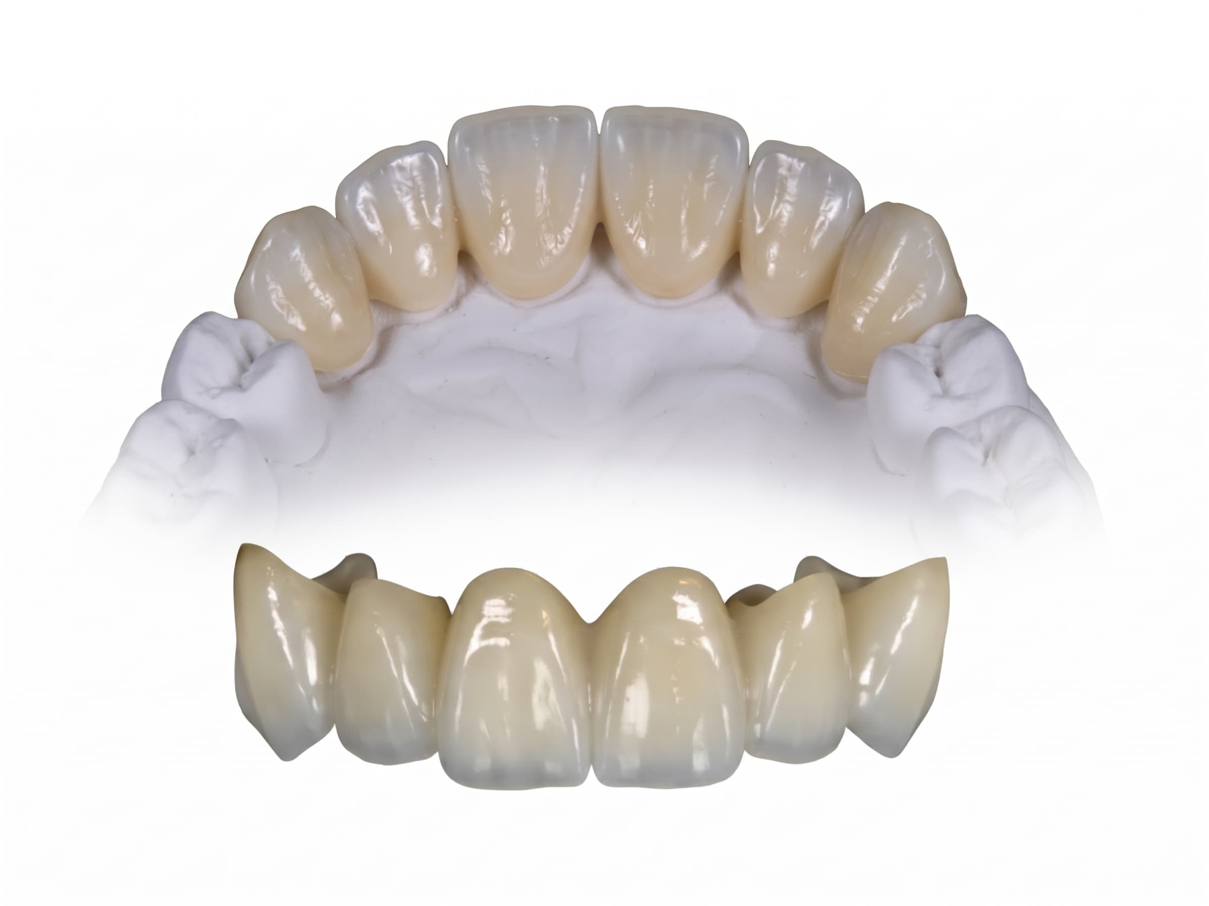 Upper and lower zirconia crown bridges